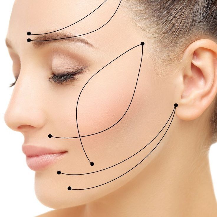 Căng chỉ da mặt có hiệu quả không và chi phí giá bao nhiêu?