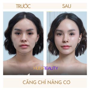 7 Điều Cần Biết Trước Khi Căng Chỉ Da Mặt