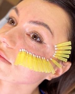 7 điều về căng chỉ da mặt giúp bạn trẻ hóa, xóa nhăn