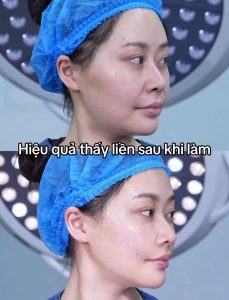 Căng Chỉ Có Đau Không