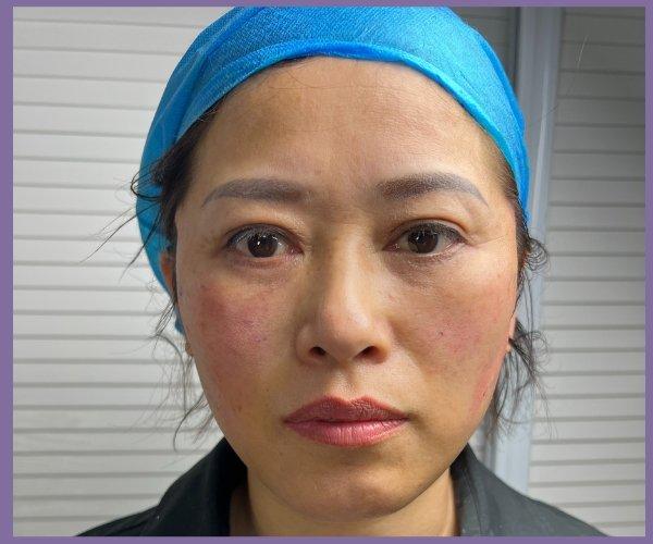 Căng Chỉ Có Để Lại Biến Chứng Không