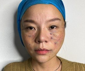 Căng Chỉ Có Để Lại Biến Chứng Không