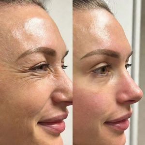 Xóa nhăn vùng trán, mắt