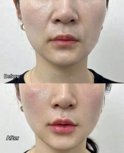 Căng Chỉ Da Mặt Có Hết Nhăn Vĩnh Viễn Không. Chuyên Gia Giải Đáp