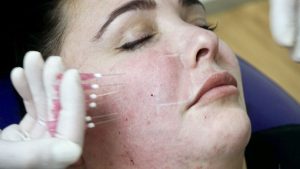 Căng Chỉ Da Mặt Có Nguy Hiểm Không