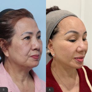 Căng Chỉ Da Mặt Có Thể Trẻ Hơn Bao Nhiêu Tuổi