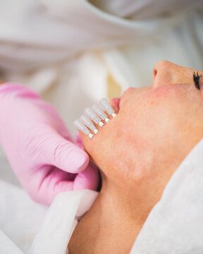 Căng Chỉ Khác Phẫu Thuật Nâng Cơ Như Thế Nào