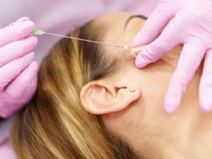 Căng Chỉ Khác Phẫu Thuật Nâng Cơ Như Thế Nào