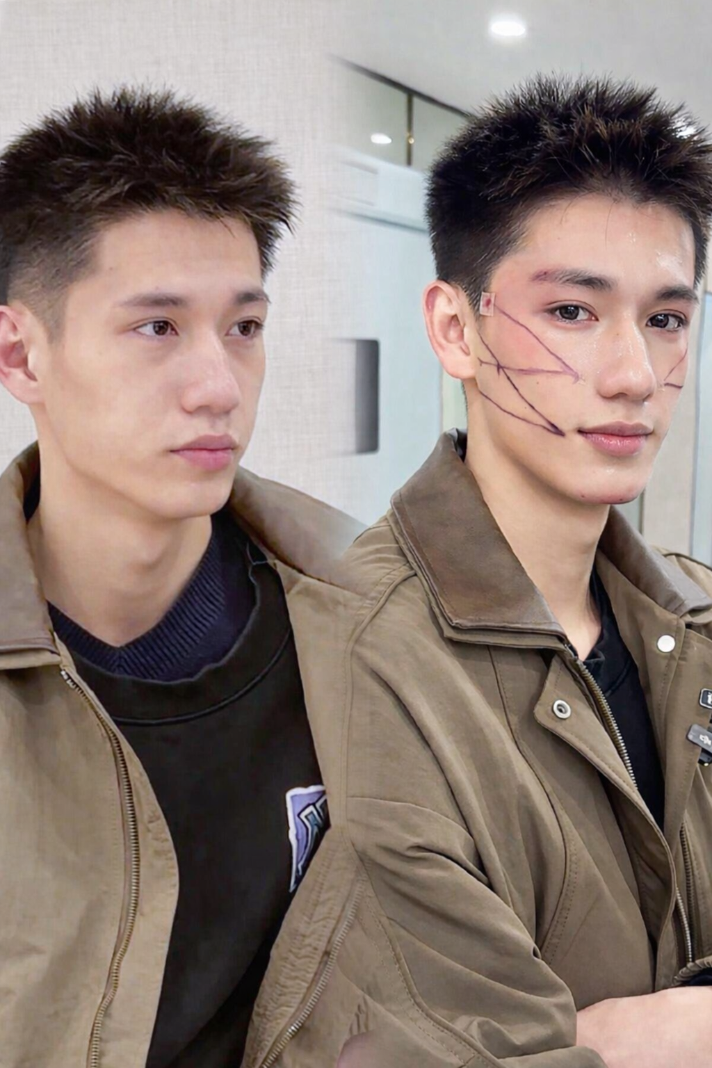 Căng Chỉ Nâng Cơ Có Hết Nhăn Vĩnh Viễn Không? Sự Thật Y Khoa