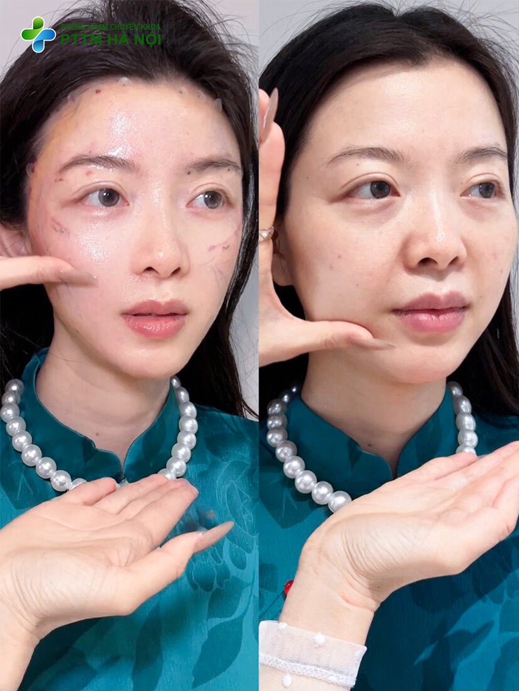 Căng Chỉ Nâng Cơ Có Hết Nhăn Vĩnh Viễn Không