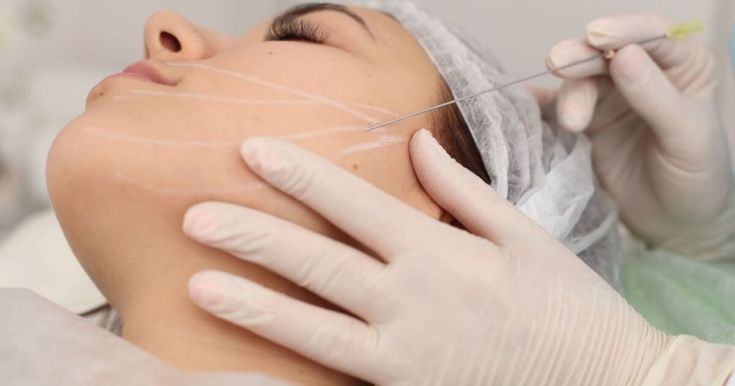 Căng Da Mặt Bằng Chỉ Là Gì