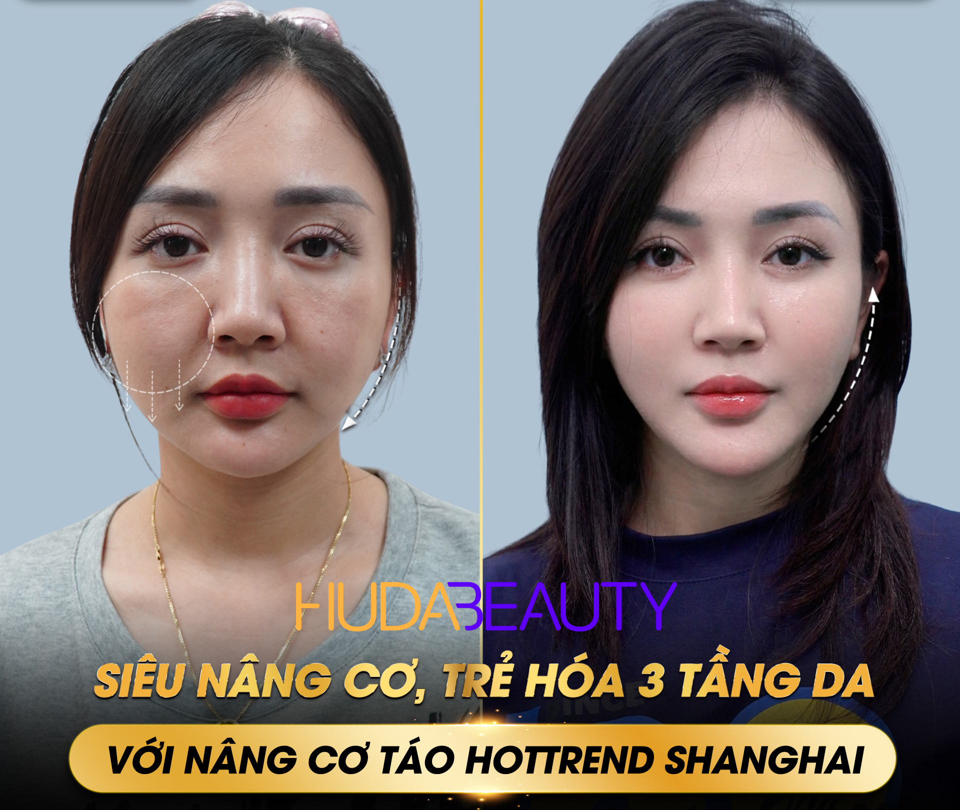 Căng chỉ da mặt vs HIFU