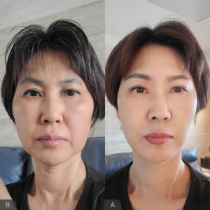 Cách chăm sóc da sau khi căng cấy chỉ collagen