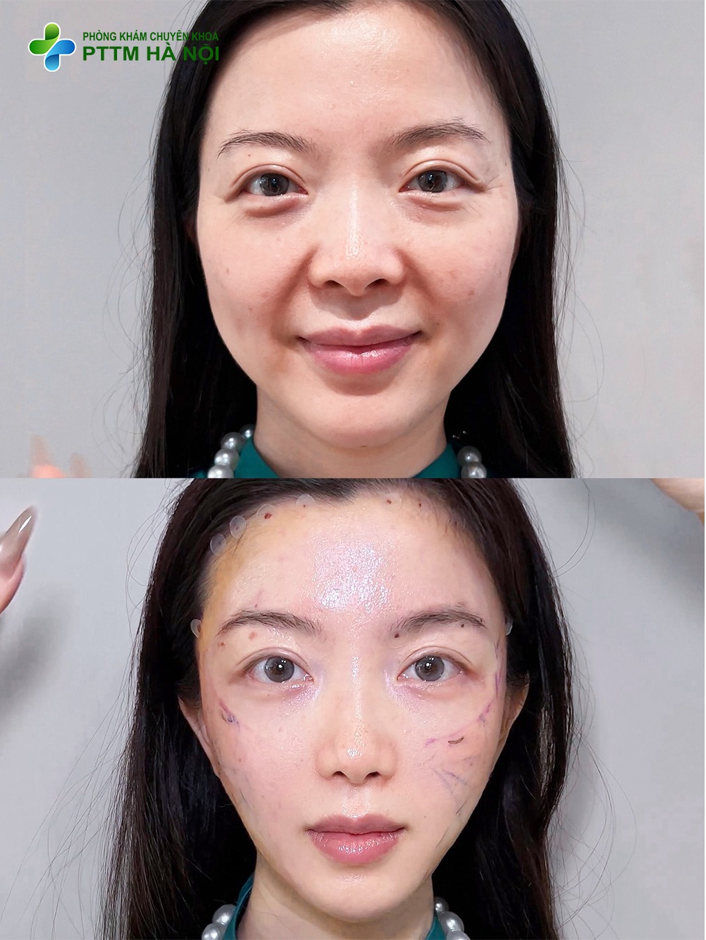 Căng chỉ nâng cơ giá bao nhiêu