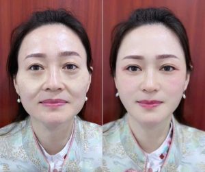 Căng chỉ nâng cơ giá bao nhiêu