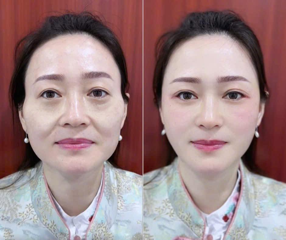 Căng chỉ nâng cơ giá bao nhiêu