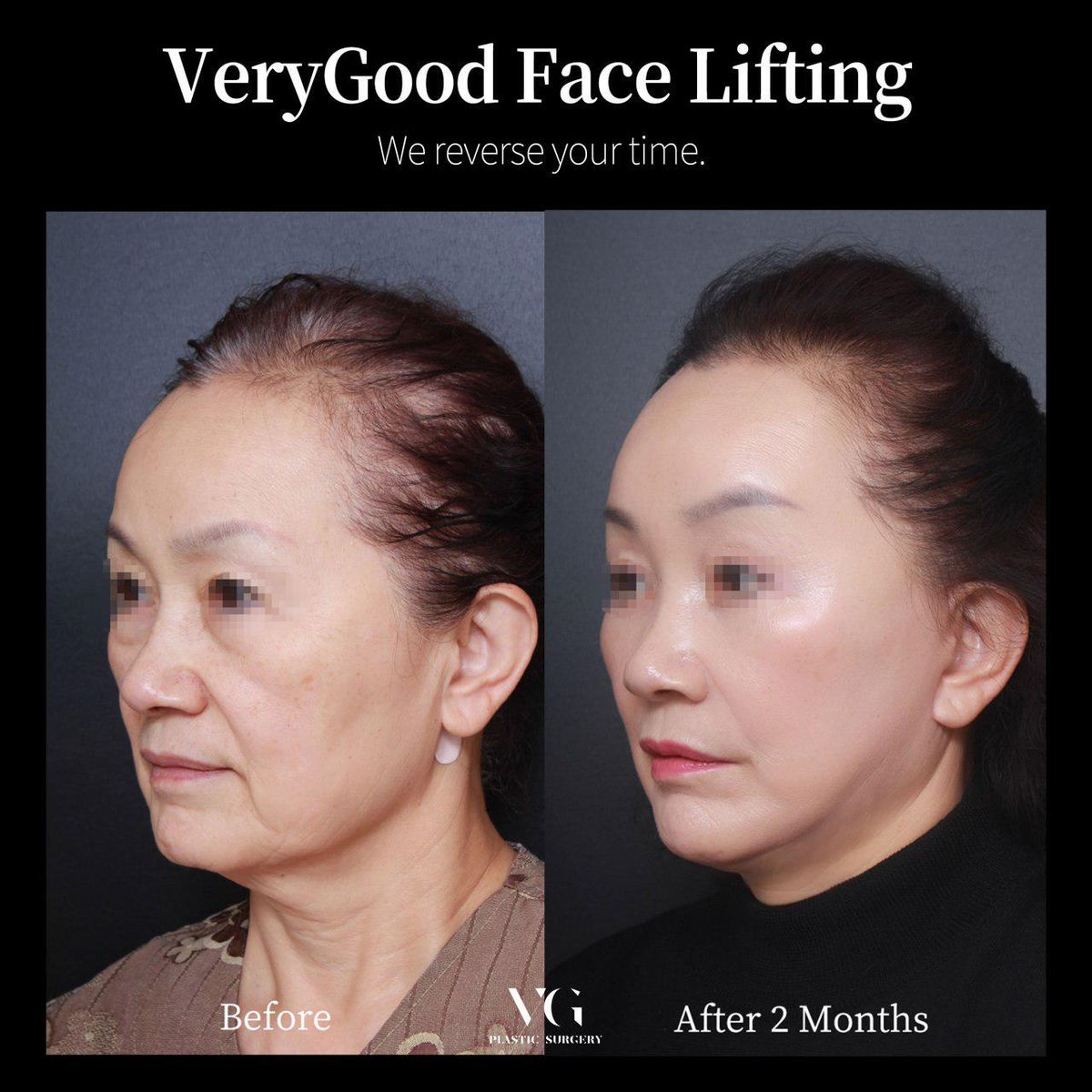 Căng chỉ nâng cơ