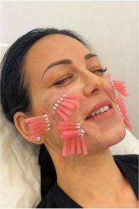 Má sệ, rãnh cười sâu căng chỉ có hết không