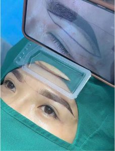 Nâng Cung Chân Mày Bằng Chỉ Có Hiệu Quả Không