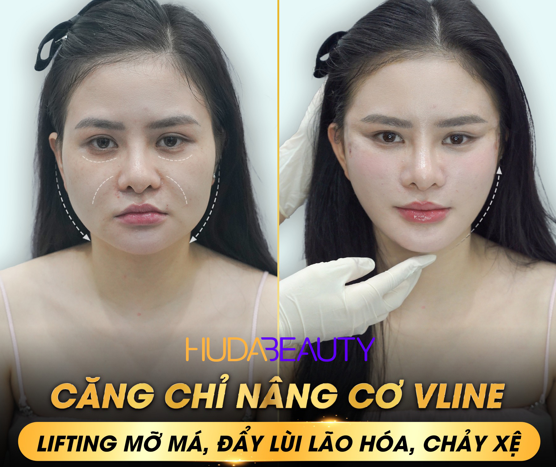 Bao Nhiêu Tuổi Thì Nên Đi Căng Chỉ Da Mặt