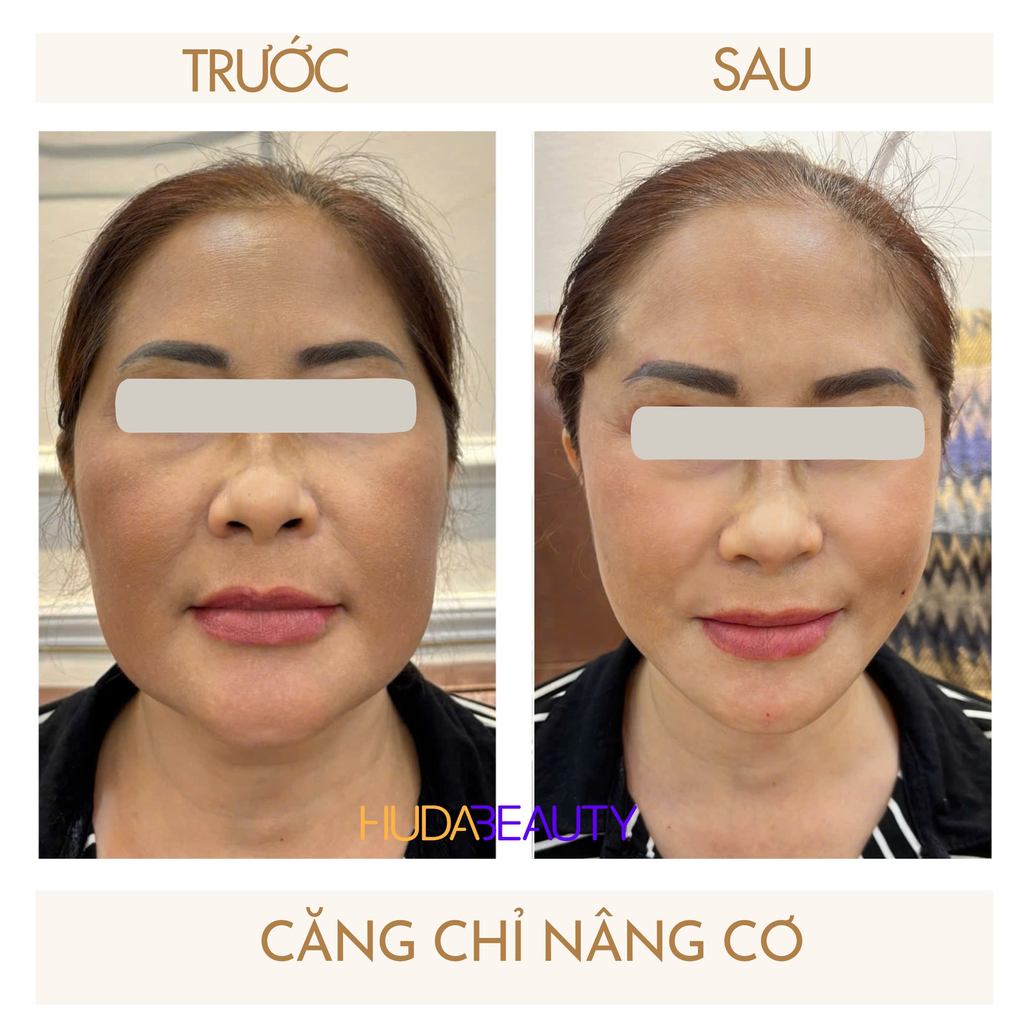 Bao Nhiêu Tuổi Thì Nên Đi Căng Chỉ Da Mặt