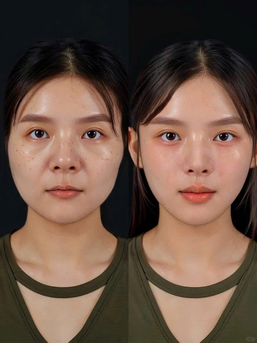 Căng Chỉ, BAP, Meso – Đâu Là Giải Pháp Phù Hợp Cho Da Lão Hóa