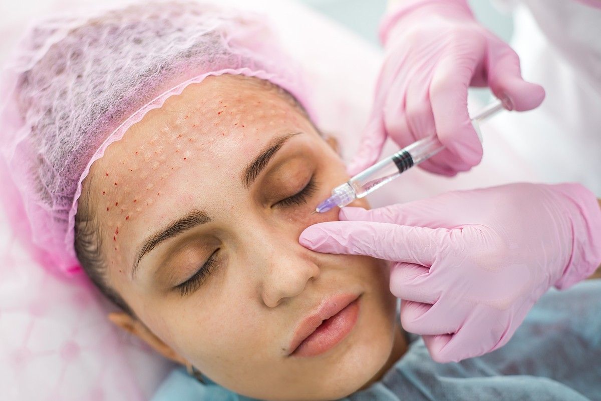 Căng Chỉ, BAP, Meso – Đâu Là Giải Pháp Phù Hợp Cho Da Lão Hóa