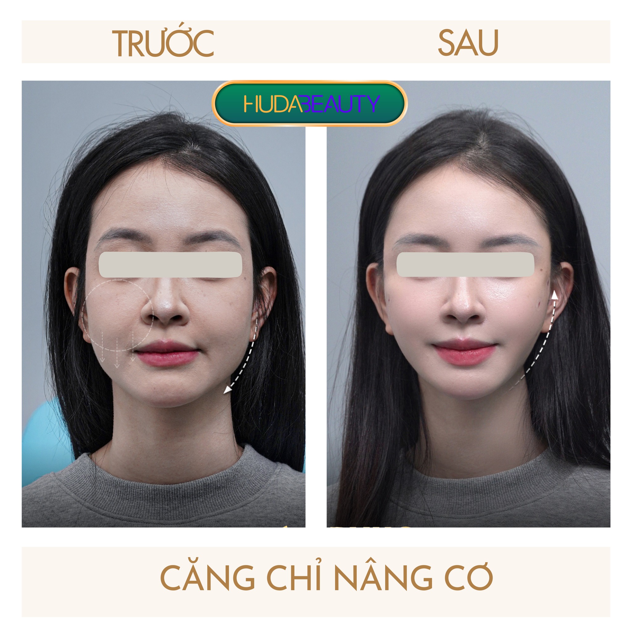 Căng Chỉ Bị Sưng Mặt Thì Nên Làm Gì
