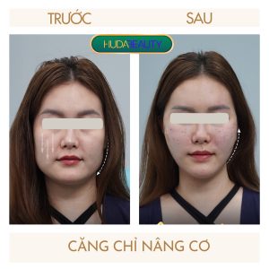 Căng Chỉ Bị Sưng Mặt Thì Nên Làm Gì
