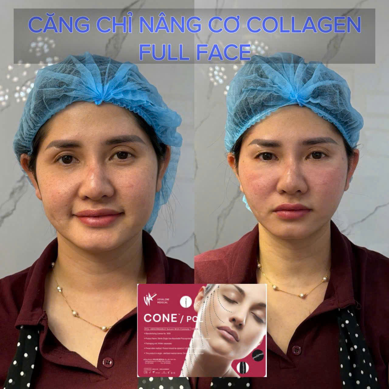 Căng Chỉ Có Để Lại Sẹo Không