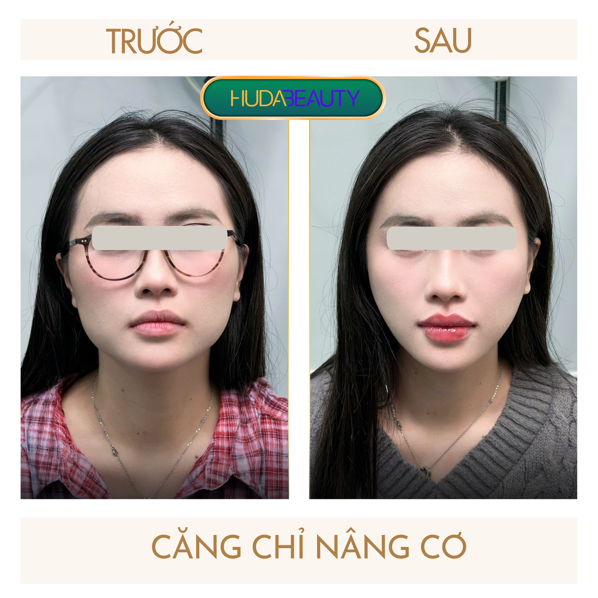 Căng Chỉ Có Để Lại Sẹo Không
