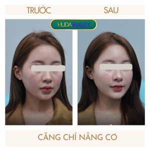 Căng Chỉ Collagen Có Phải Giải Pháp Tốt Nhất Cho Da Chảy Xệ?