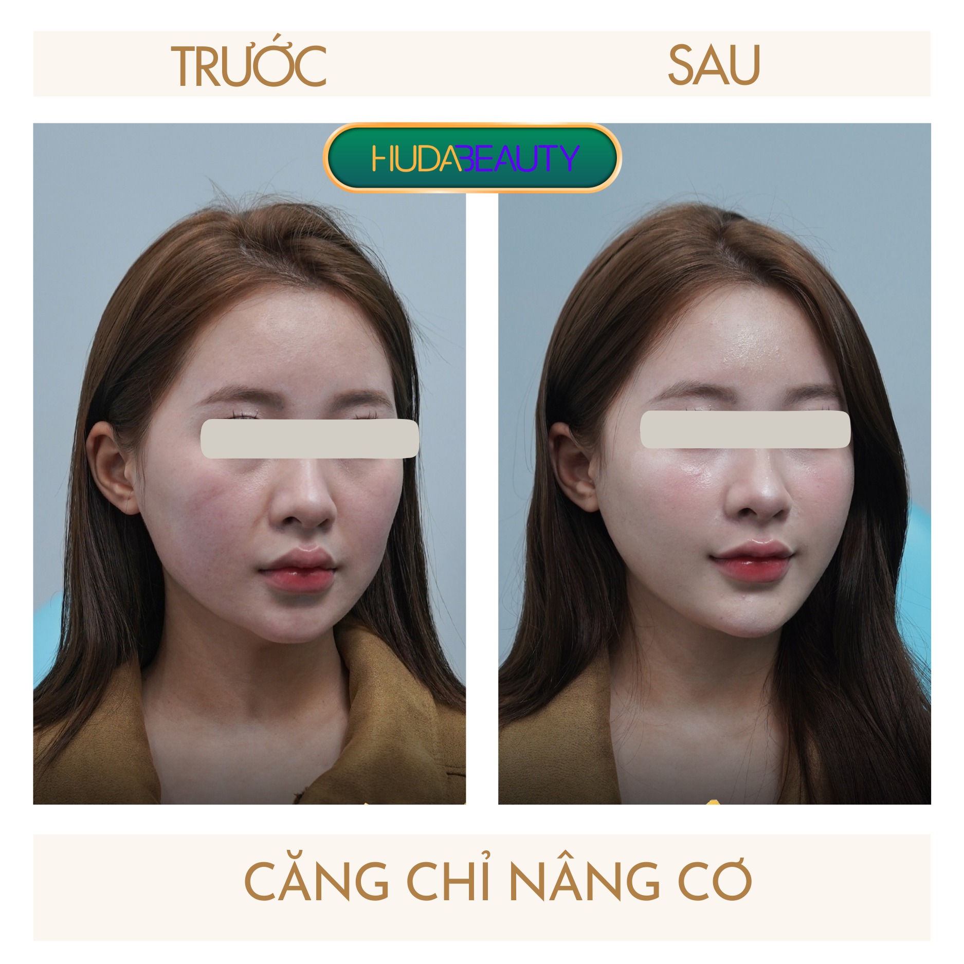 Căng Chỉ Collagen Có Phải Giải Pháp Tốt Nhất Cho Da Chảy Xệ?