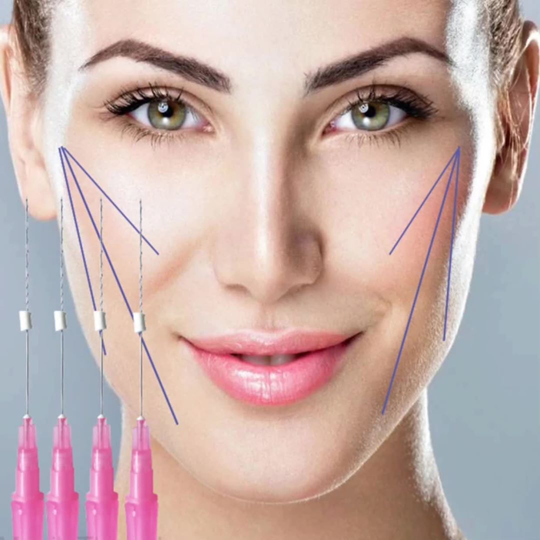 Căng Chỉ Collagen Có Phải Giải Pháp Tốt Nhất Cho Da Chảy Xệ?