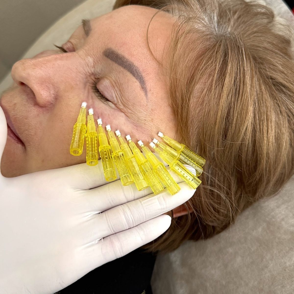 Căng Chỉ Collagen Hoạt Động Như Thế Nào Trên Da