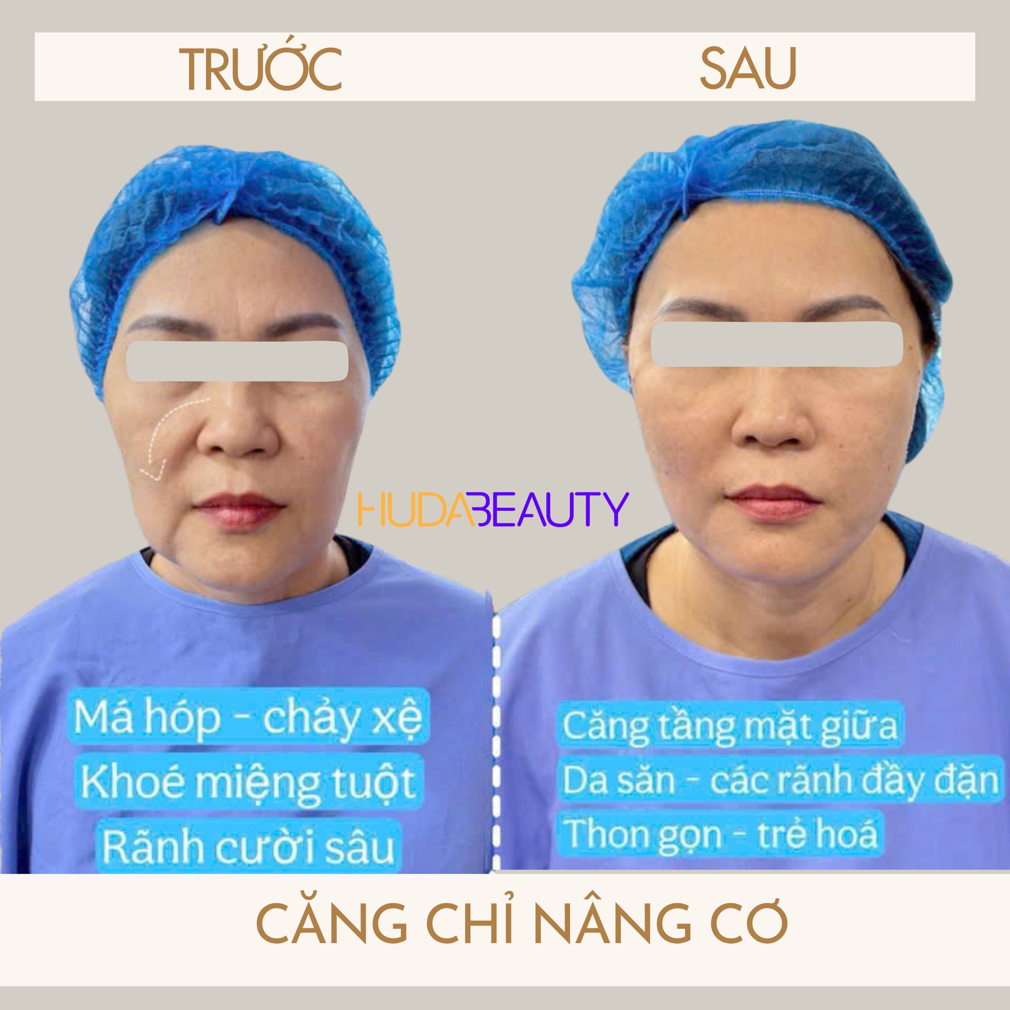 Căng Chỉ Da Mặt Có Đau Không