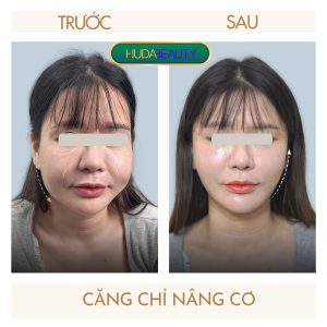 Căng Chỉ Da Mặt Nhiều Lần Khiến Da Chảy Xệ Hơn Không