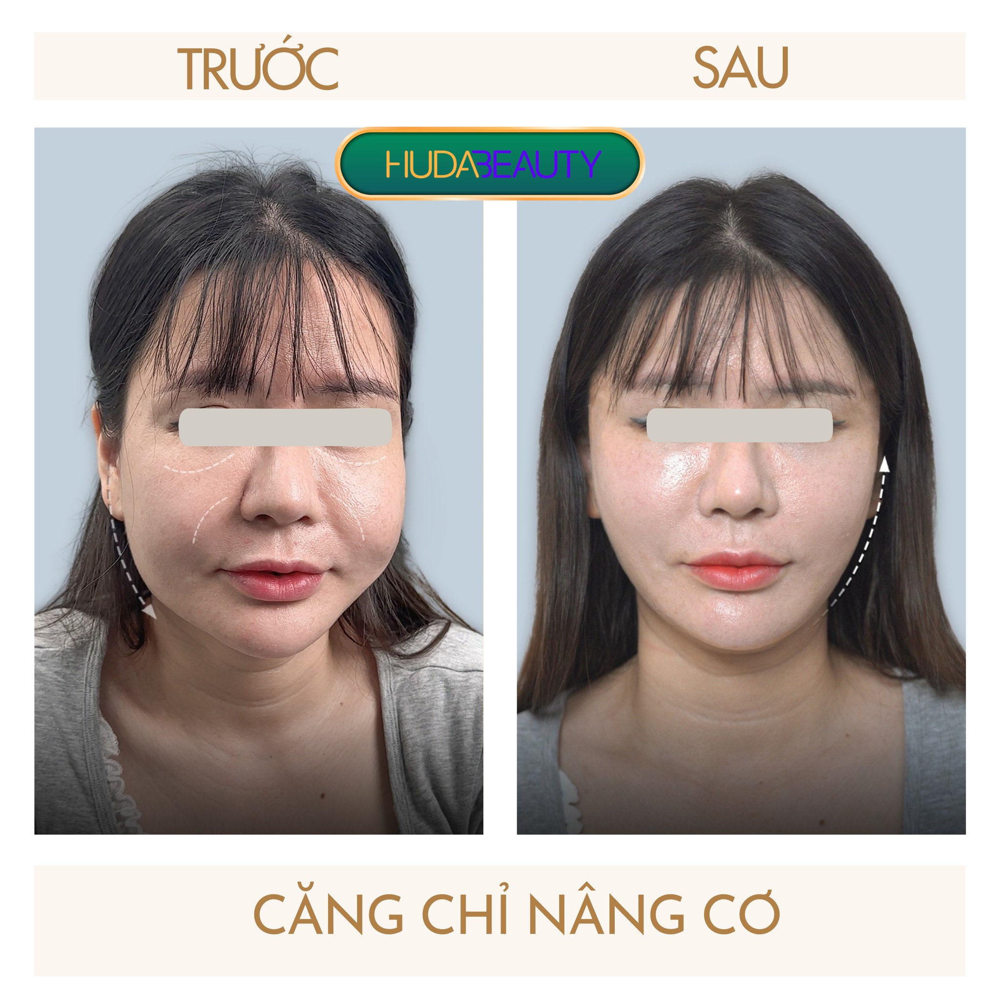 Căng Chỉ Da Mặt Nhiều Lần Khiến Da Chảy Xệ Hơn Không