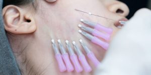 Căng Chỉ Giá Rẻ – Tiết Kiệm Hay Đánh Đổi Nhan Sắc