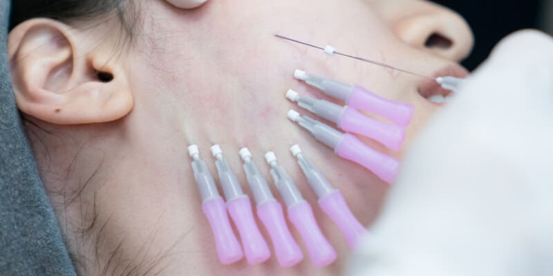 Căng Chỉ Giá Rẻ – Tiết Kiệm Hay Đánh Đổi Nhan Sắc