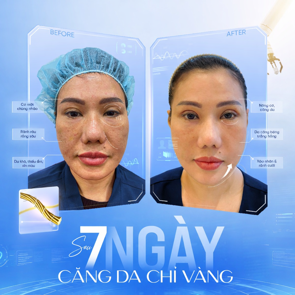 Căng Chỉ Vàng Là Gì. Sự Thật Không Phải Ai Cũng Biết