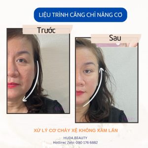 Căng Chỉ Vào Da Thì Sợi Chỉ Có Tan Không