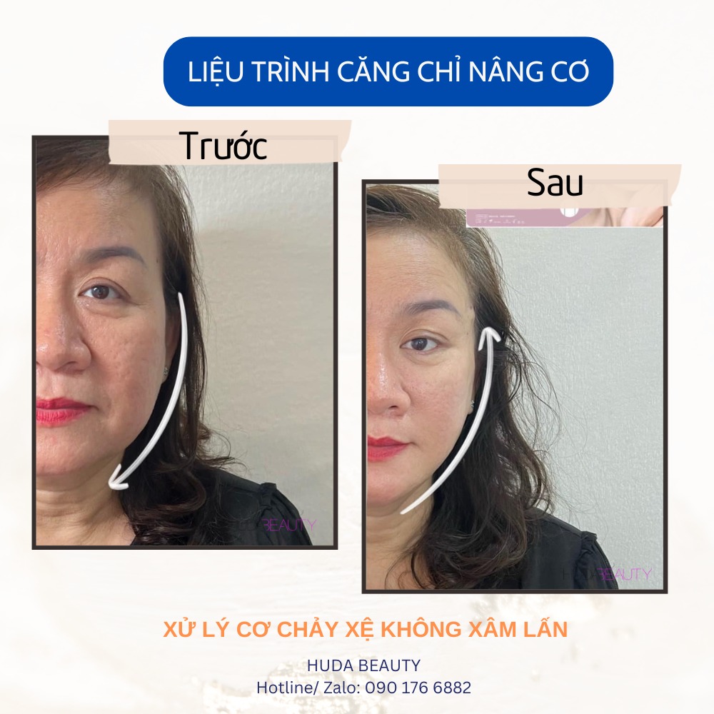 Căng Chỉ Vào Da Thì Sợi Chỉ Có Tan Không