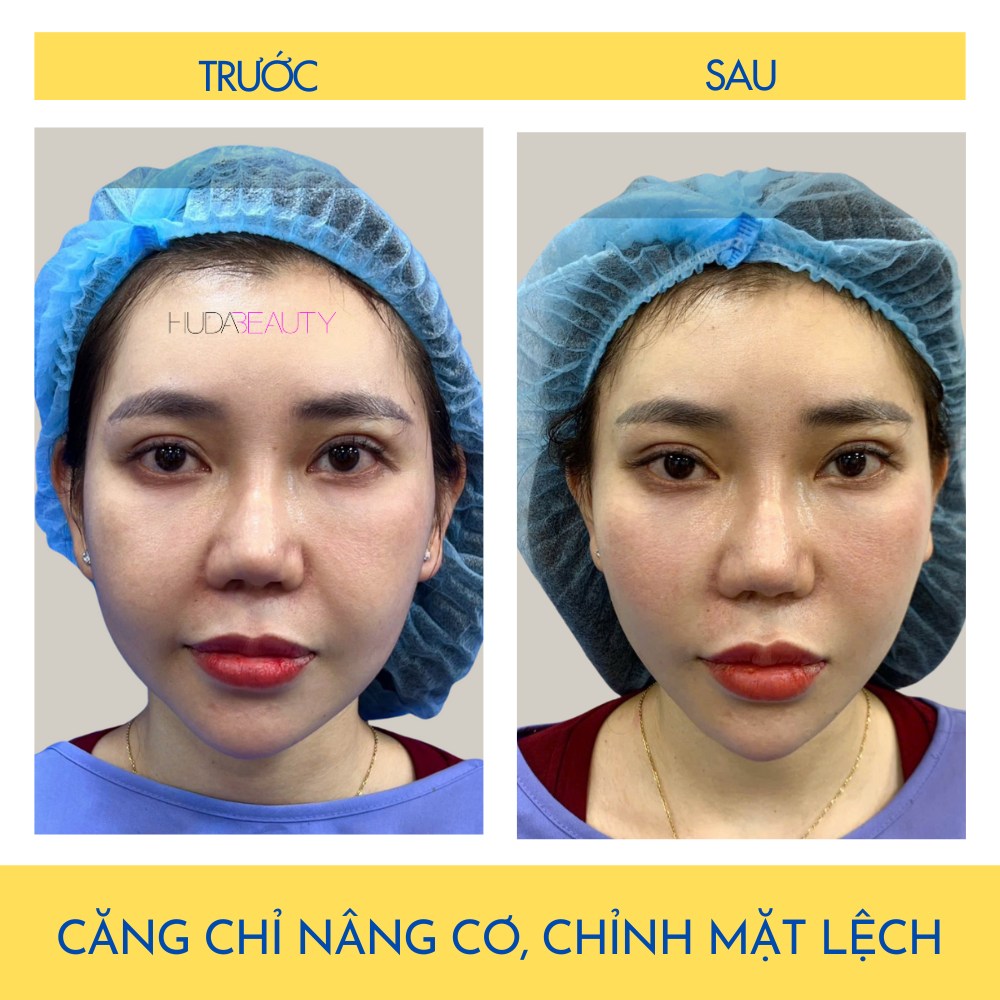 Căng Chỉ Vào Da Thì Sợi Chỉ Có Tan Không