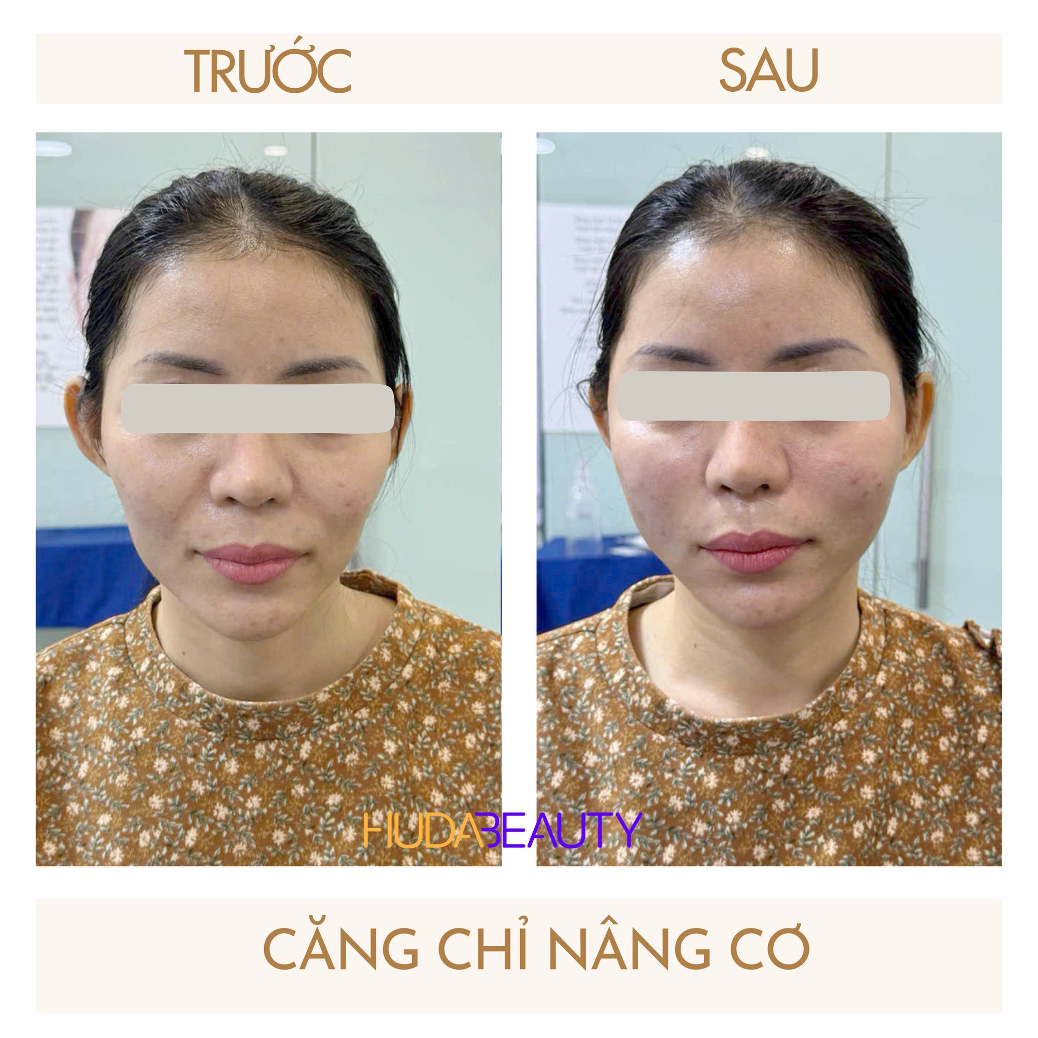 Mặt Xệ Thì Nên Đi Căng Chỉ Không