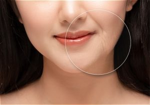 Nâng Cơ, Xóa Nhăn Trẻ Hóa Bằng Căng Chỉ Da Mặt