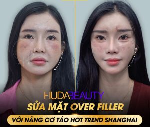 Quy Trình Căng Chỉ Da Mặt Chuẩn Y Khoa Diễn Ra Như Thế Nào