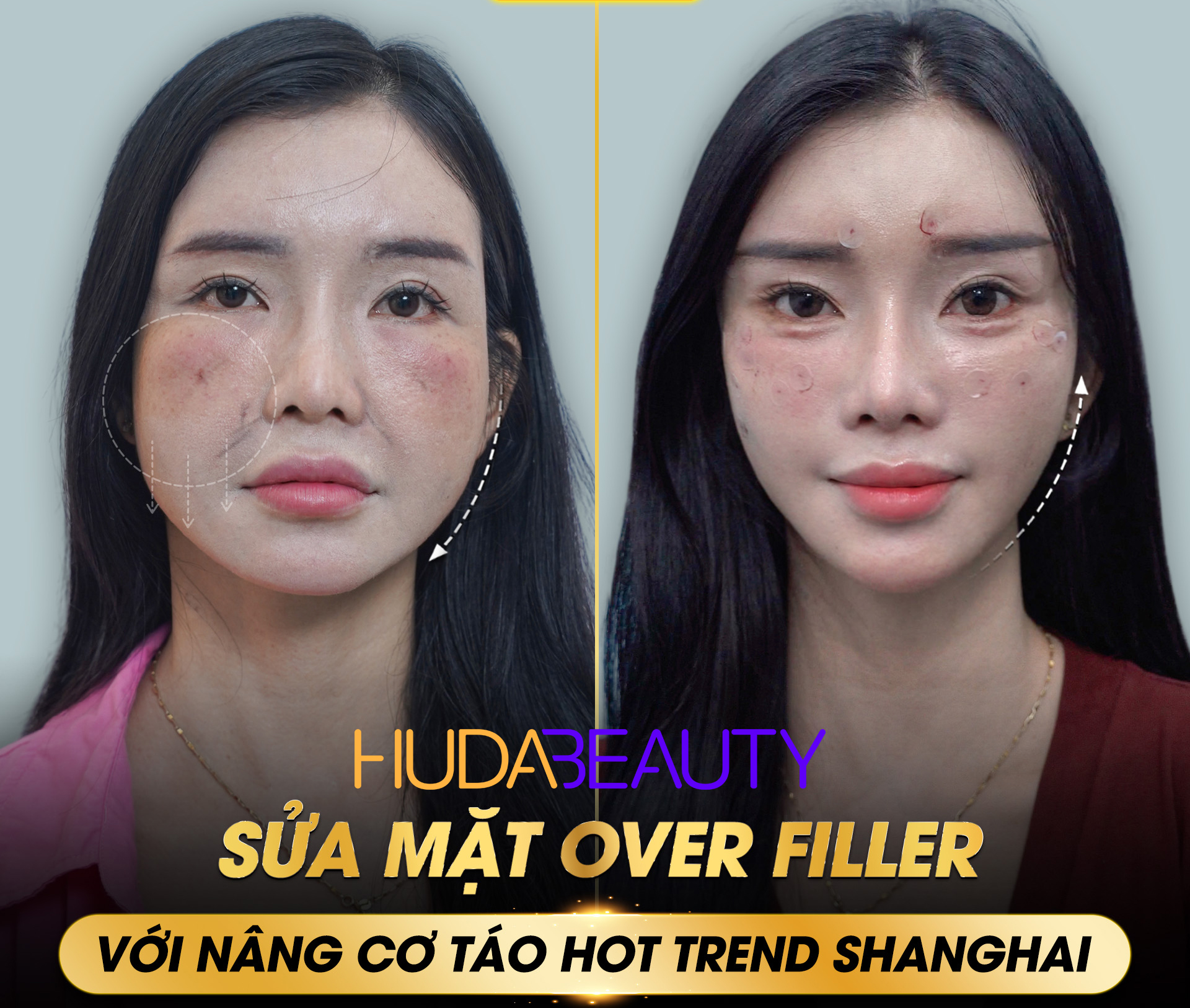 Quy Trình Căng Chỉ Da Mặt Chuẩn Y Khoa Diễn Ra Như Thế Nào