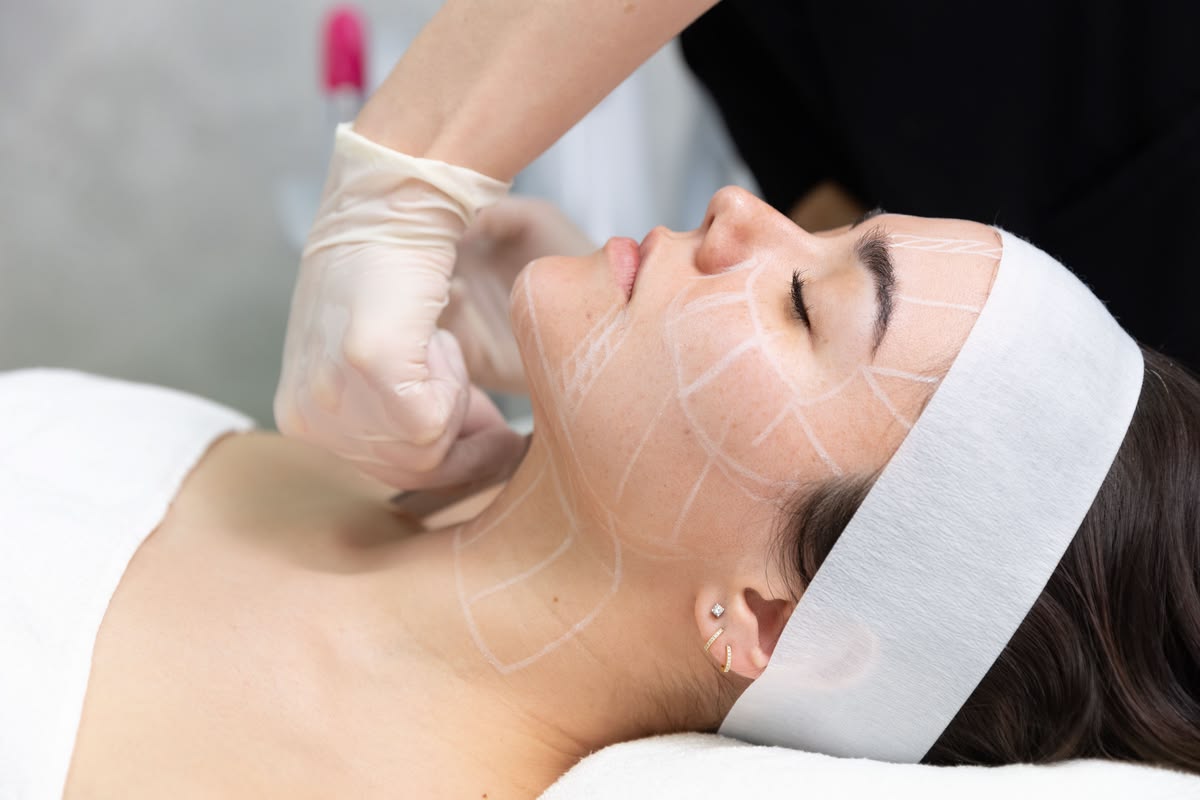 Review A-Z Quy Trình Căng Chỉ Da Mặt