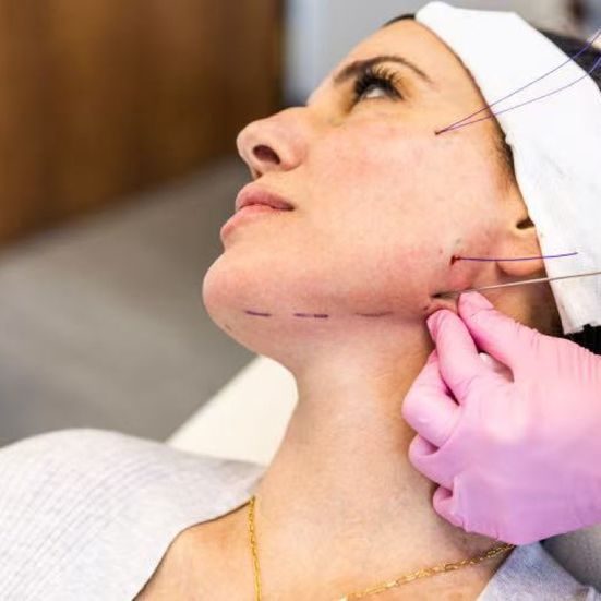 Review A-Z Quy Trình Căng Chỉ Da Mặt